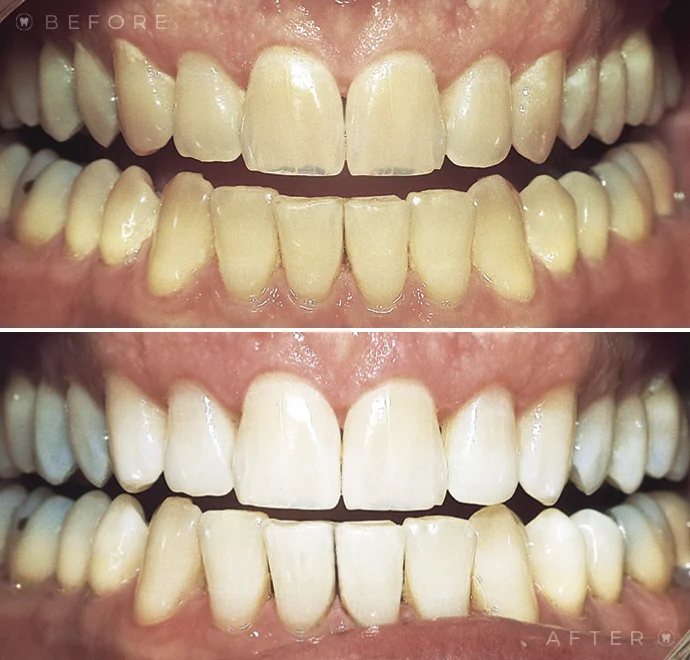 Teeth before whitening and below teeth after whitening