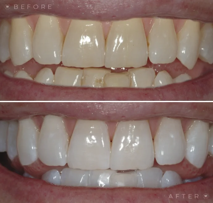 Teeth before whitening and below teeth after whitening