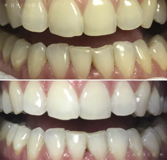 Teeth before whitening and below teeth after whitening