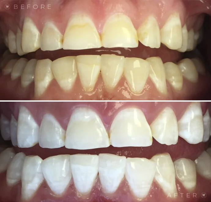 Teeth before whitening and below teeth after whitening
