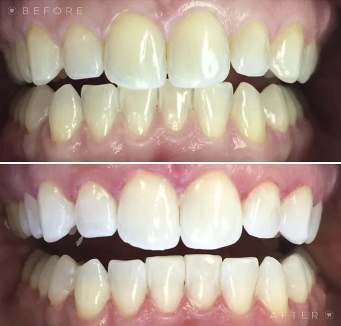Teeth before whitening and below teeth after whitening