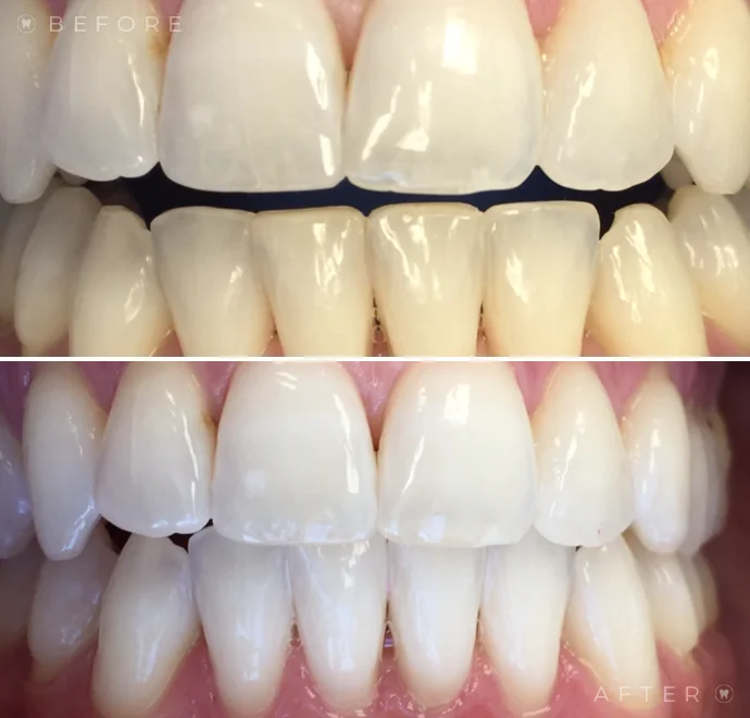 Teeth before whitening and below teeth after whitening