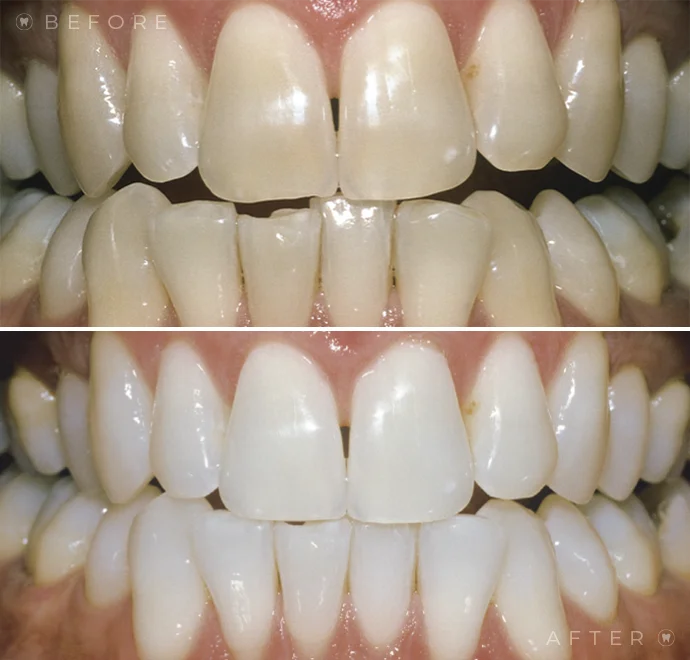 Teeth before whitening and below teeth after whitening