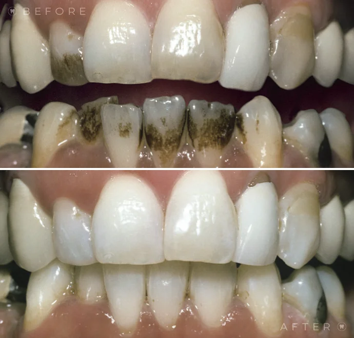 Teeth before whitening and below teeth after whitening