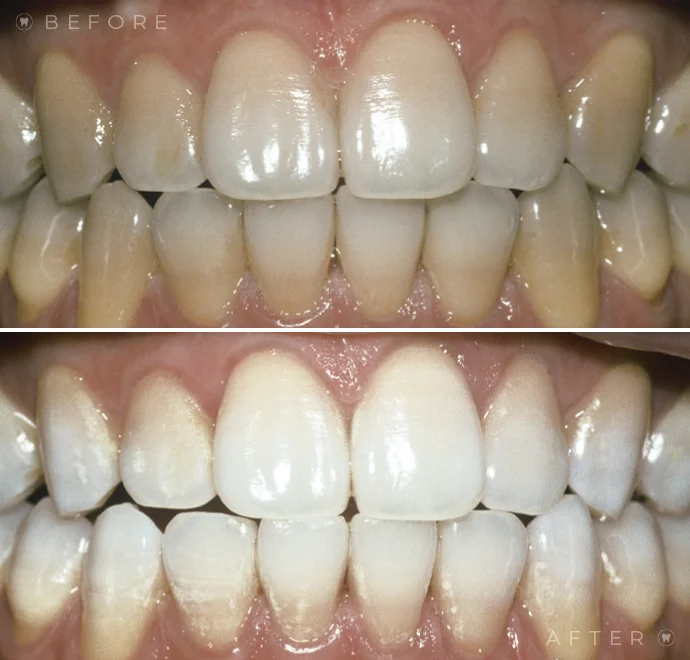 Teeth before whitening and below teeth after whitening